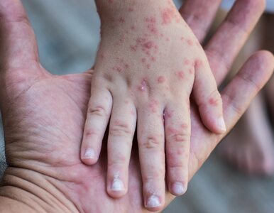 Wysypka alergiczna – co to jest, zdjęcia, przyczyny i leczenie
