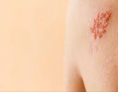 Miniatura: Półpasiec to groźna choroba. Dlaczego...