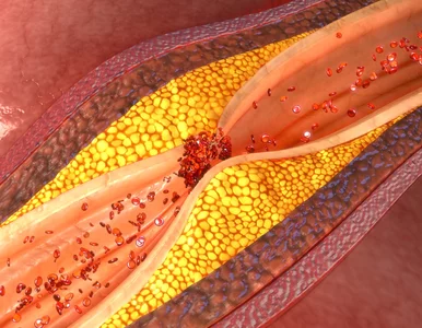 Miniatura: Nowe doniesienia na temat cholesterolu...