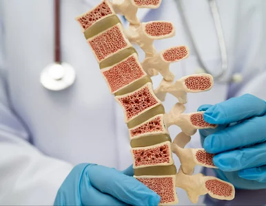Miniatura: Osteoporoza to nie jest błaha choroba,...