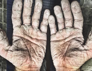 Miniatura: To dłonie 33-letniego sportowca. Jak...