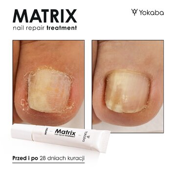 MATRIX Nail Repair Treatment pomaga w&nbsp;walce z&nbsp;tendencją do&nbsp;onycholizy