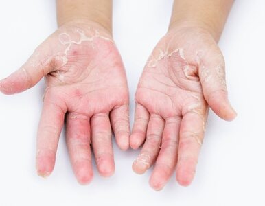 Miniatura: Grzybica dłoni – objawy, przyczyny i leczenie