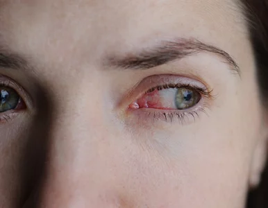 Miniatura: Polscy naukowcy chcą leczyć jaskrę...