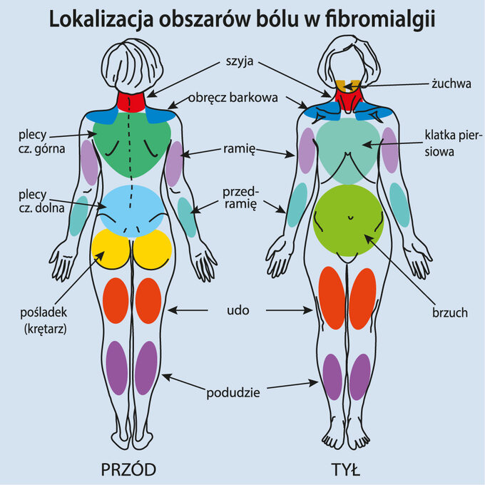 Lokalizacja obszarów bólu w fibromialgii