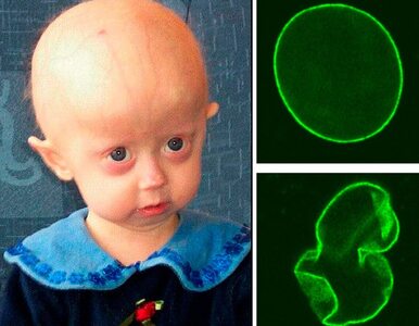 Miniatura: Progeria powoduje szybkie starzenie się u...