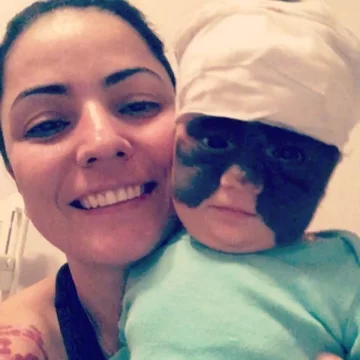 Luna Fenner po zabiegu 