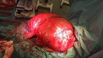 Guz ważący 42 kilogramy