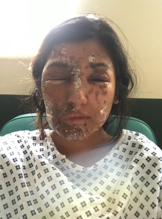 Resham Khan została oblana kwasem w dniu urodzin 