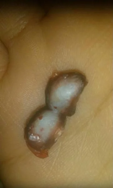 Metoda gumki recepturki 