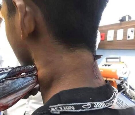 Miniatura: Ryba wbiła się w szyję nastolatka....