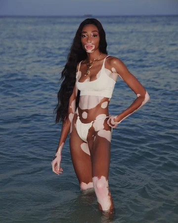 Winnie Harlow - aniołek Victoria's Secret, który cierpi na bielactwo 