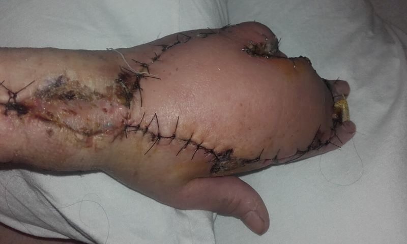 Ręka Moiry Brady po operacjach 