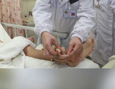 Miniatura: Chińscy lekarze przyszyli dłoń do nogi
