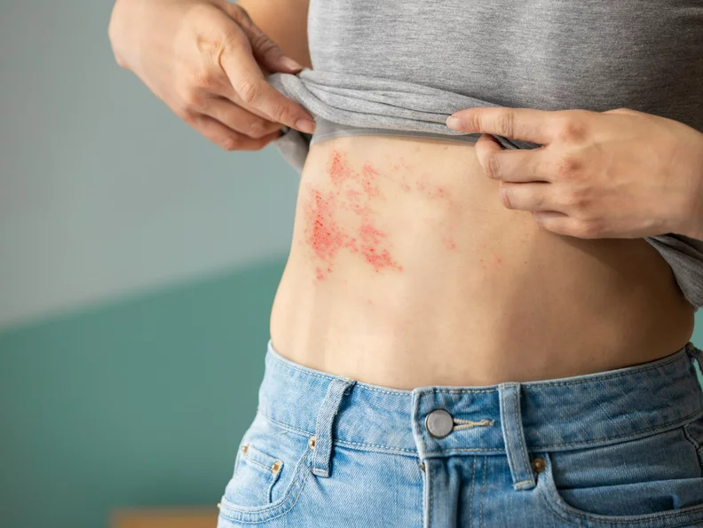 Miniatura: Półpasiec grozi milionom Polaków. Eksperci...