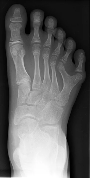 Rentgen prawej stopy osoby z polidaktylią 