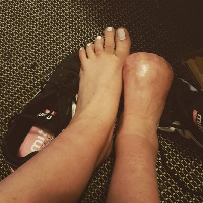 Miniatura: Poszła na fish pedicure. Musiała amputować...