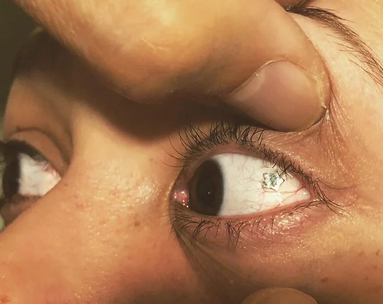 Miniatura: Biżuteria w gałce ocznej? Taki zabieg...