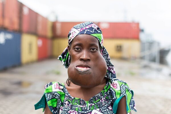 Miniatura: Miała gigantyczny guz. Operacja odmieniła...