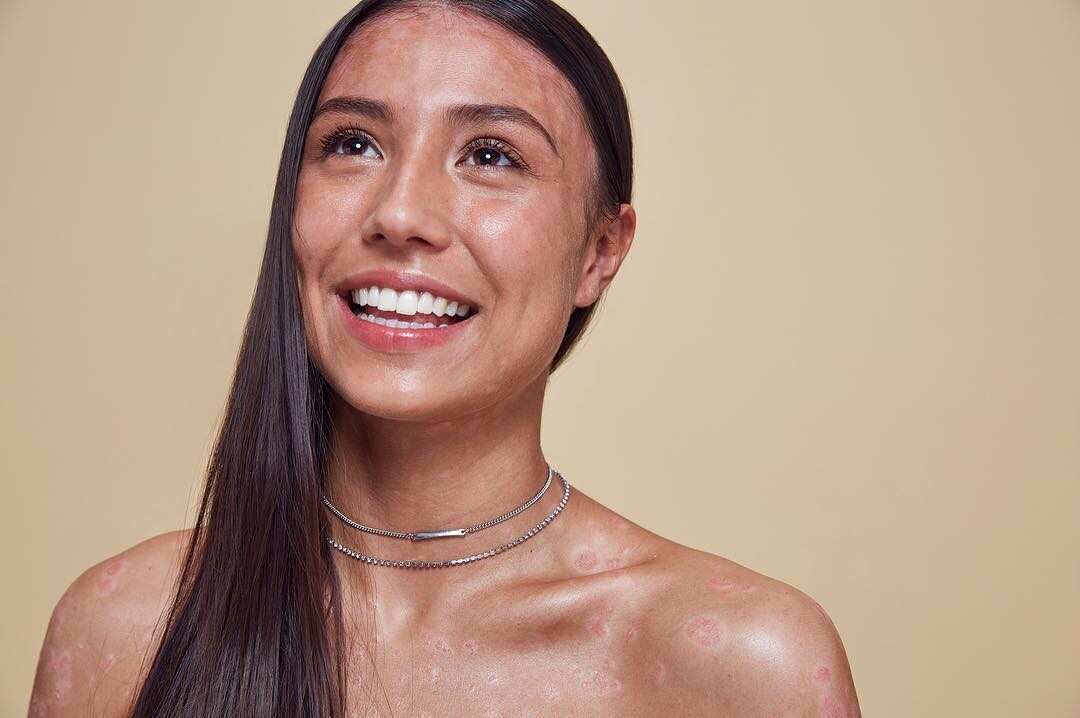 Nowa kampania marki uhonorowała kobiety z unikalnymi zmianami skórnymi 