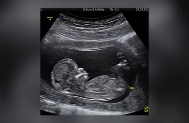 Zdjęcie USG pokazane przez Justina Biebera