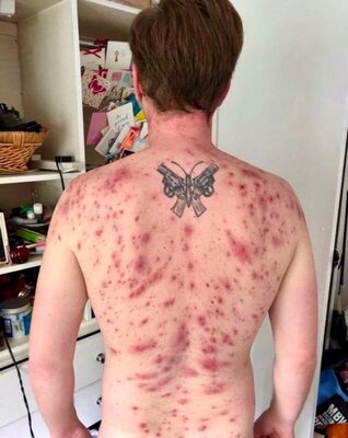 Miniatura: Brytyjczyk James Michael, który zachorował...