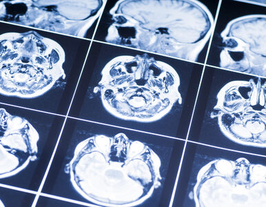 Eksperci: Skuteczna terapia może hamować zanik tkanki mózgu u chorych na SM