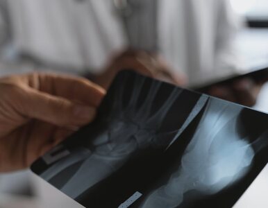 Osteoporoza – wczesna diagnoza zwiększa szanse na skuteczne leczenie