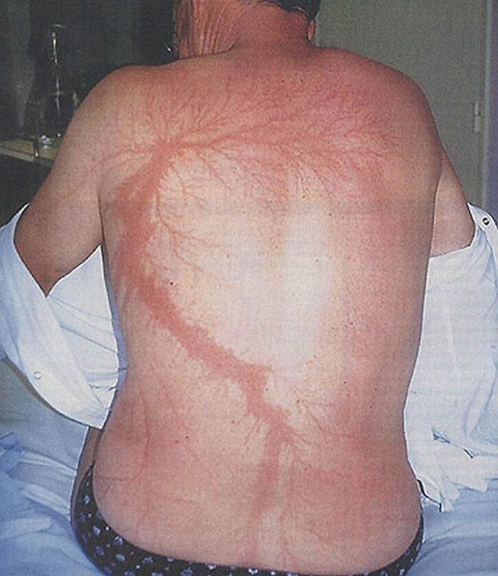 Zdjęcie ciała po uderzeniu pioruna 