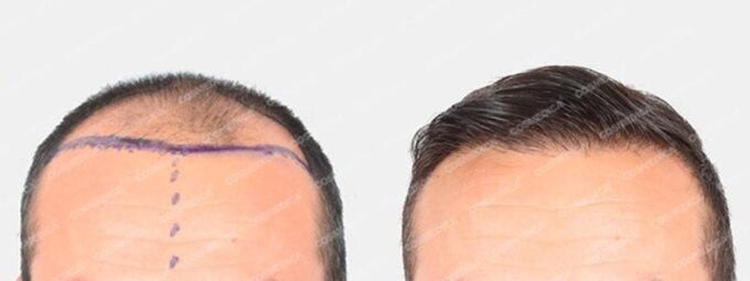 Przeszczep włosów – porównanie przed i po