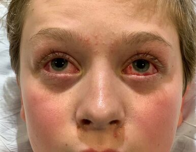 Czerwone oczy i dłonie, sine stopy – skutki COVID-19 u 11-latka