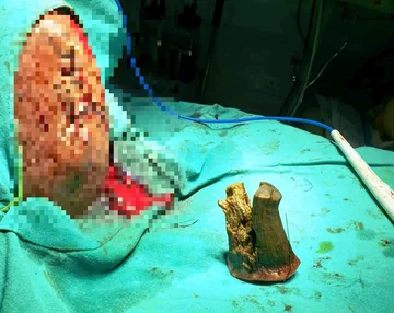 Hindus Shyam Lal Yadav miał na głowie 10 cm róg 