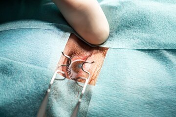 System fakoemulsyfikacji opracowany przez szwajcarską firmę i&nbsp;rozwijany przez Rayner, wyr&oacute;żnia się bezprzewodową konstrukcją, zintegrowanym kompresorem i&nbsp;zaawansowanym systemem kontroli ciśnienia w&nbsp;oku