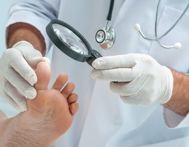 Czerniak paznokcia – przyczyny, jak się objawia, diagnostyka i leczenie