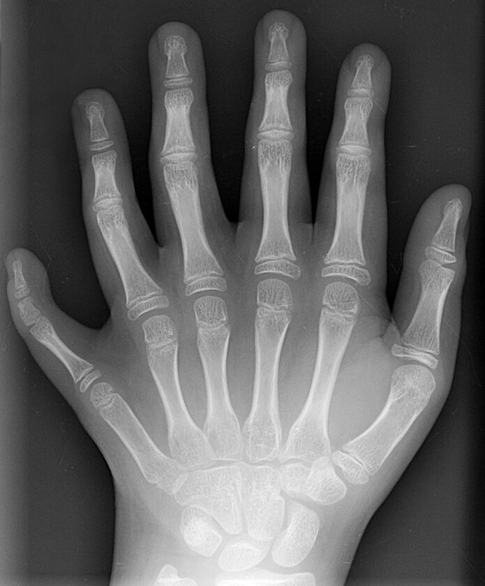 Rentgen lewej dłoni osoby z polidaktylią 