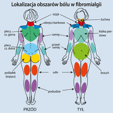 Lokalizacja obszar&oacute;w b&oacute;lu w&nbsp;fibromialgii