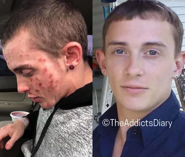 Zdjęcie przed i po wyjściu z nałogu 