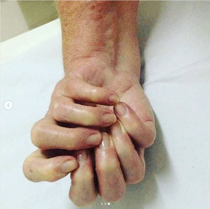 Ulnar dimelia - bardzo rzadki „syndrom lustrzanej ręki” 