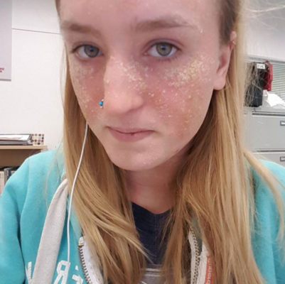 Miniatura: Kobieta cierpi na atopowe zapalenie skóry....