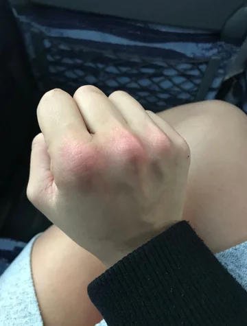 Dłoń Leanny Carr po uderzeniu 