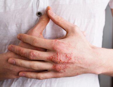 Miniatura: Egzema na dłoniach – przyczyny, leczenie i...
