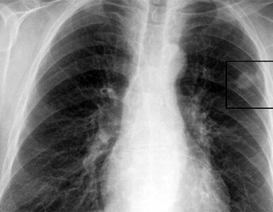 Miniatura: Nowa nadzieja dla chorych na raka płuc?