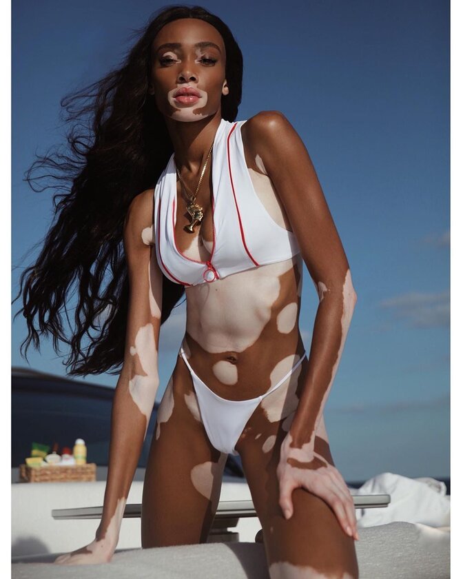 Winnie Harlow - aniołek Victoria's Secret, który cierpi na bielactwo 