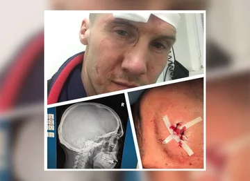 Mezo pokazał zdjęcia obrażeń po wypadku 