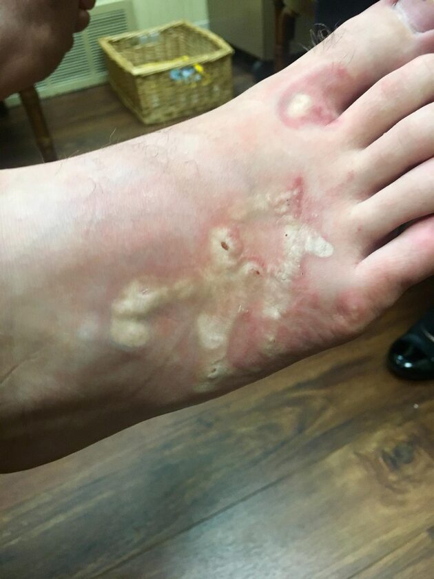 Zainfekowana stopa Michaela Dumasa 
