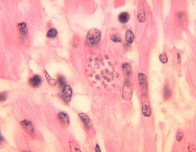 Miniatura: „Choroba całujących pluskiew”...