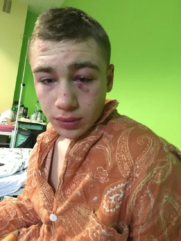Zdjęcia pobitego 