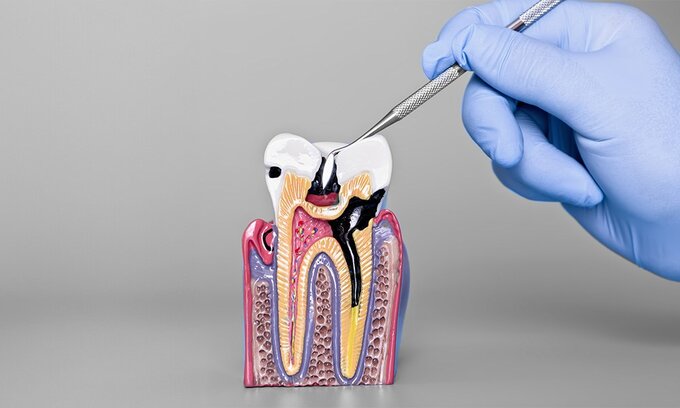Model zęba z&nbsp;pr&oacute;chnicą