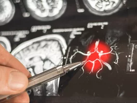 Miniatura: Będzie zmiana w leczeniu alzheimera? Jest...