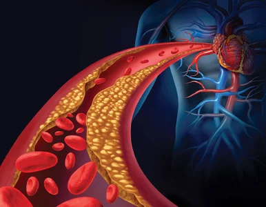 Miniatura: Cholesterol VLDL czy LDL? Jaka jest różnica?